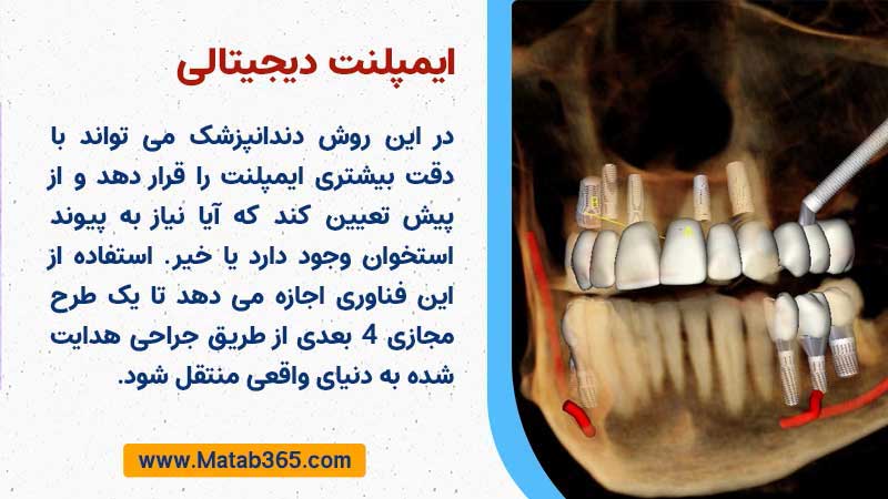 ایمپلنت دیجیتال Digital Implant چیست؟