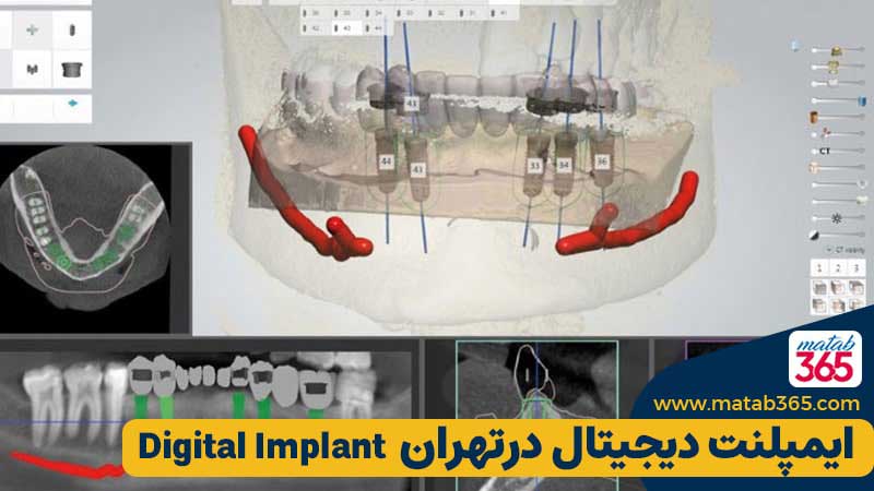 ایمپلنت دیجیتال در تهران