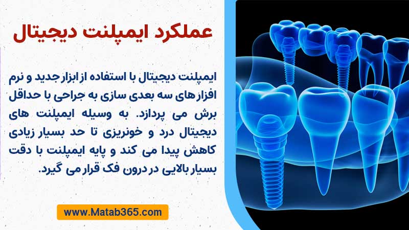 عملکرد ایمپلنت دیجیتال