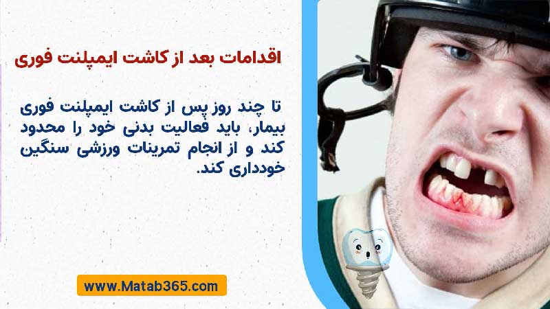 اقدامات لازم پس از کاشت ایمپلنت یک روزه