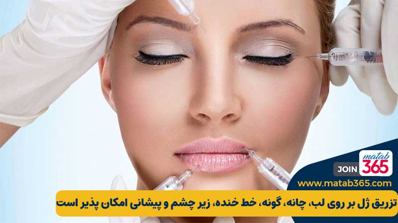 امکان تزریق فیلر یا ژل در نقاط متفاوت صورت