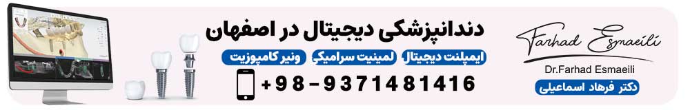 ایمپلنت یک روزه در اصفهان توسط دکتر فرهاد اسماعیلی