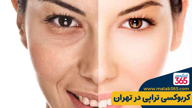 کربوکسی تراپی در تهران