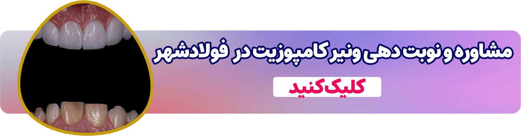 برای مشاوره و نوبت دهی ونیر کامپوزیت فولادشهر کلیک کنید