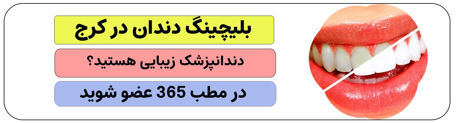 برای انجام بلیچینگ دندان در کرج ثبت نام کنید