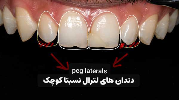 دندان های لترال کوچک قبل از ونیر کامپوزیت