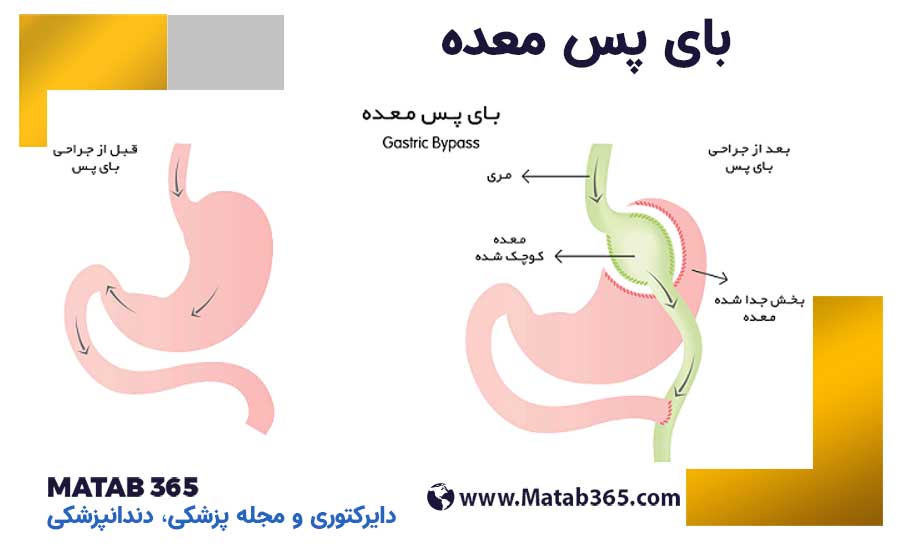 بای پس معده