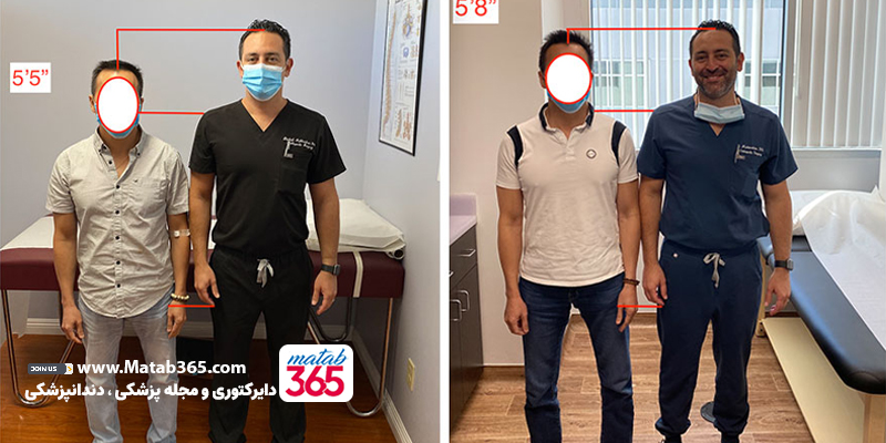 قبل و بعد عمل افزایش قد