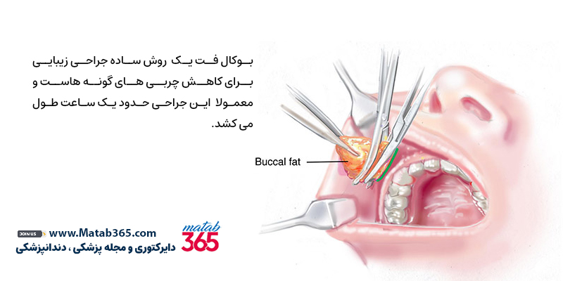 مدت زمان جراحی بوکال فت