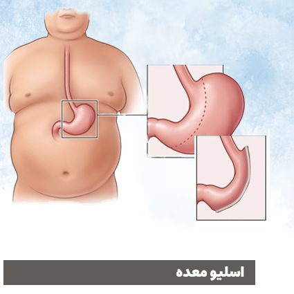 اسلیو معده