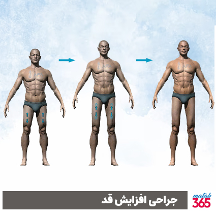 جراحی افزایش قد