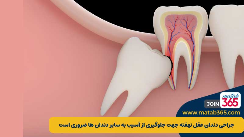 چه زمانی کشیدن دندان عقل ضروری است