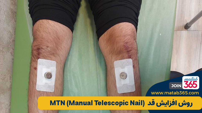 روش افزایش قد MTN