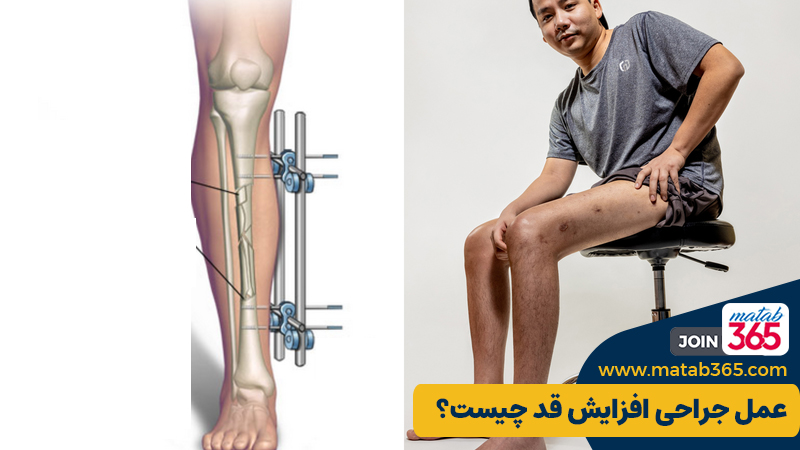 عمل جراحی افزایش قد چیست