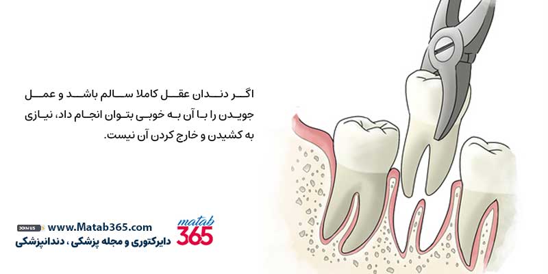 چه زمانی نباید دندان عقل را کشید