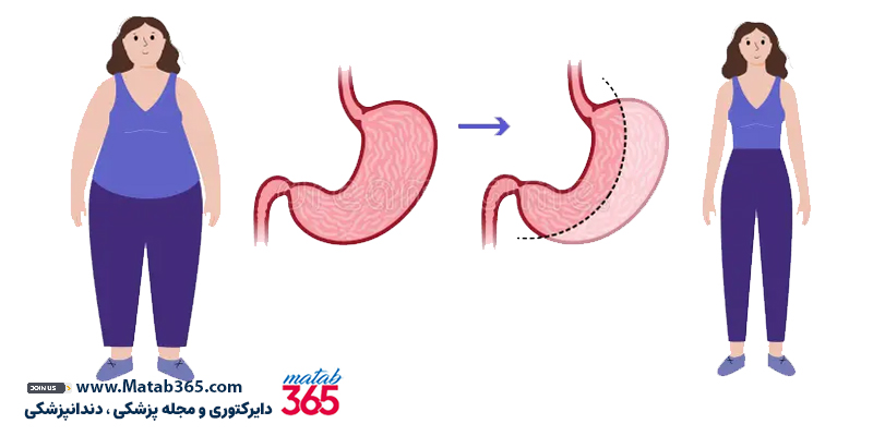 عمل اسلیو معده