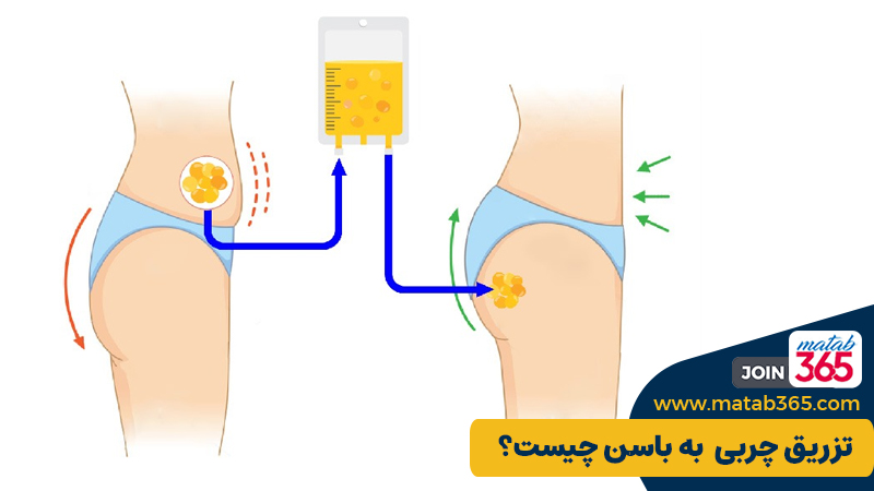 تزریق چربی به باسن چیست؟