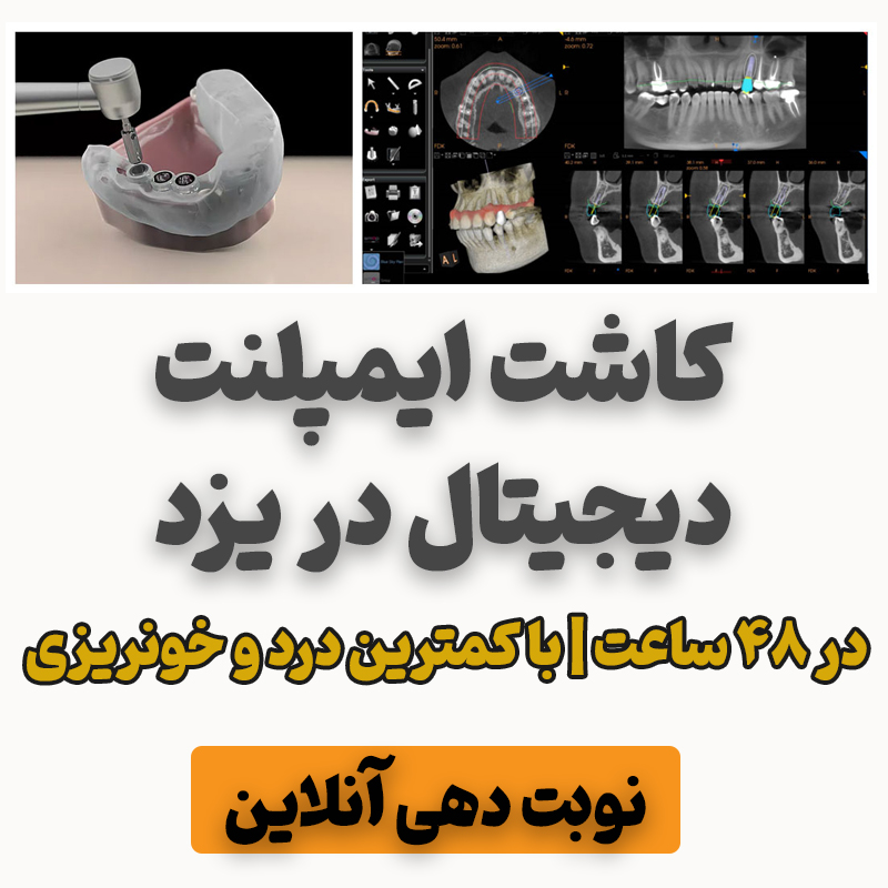 نوبت دهی ایمپلنت دیجیتال در یزد 