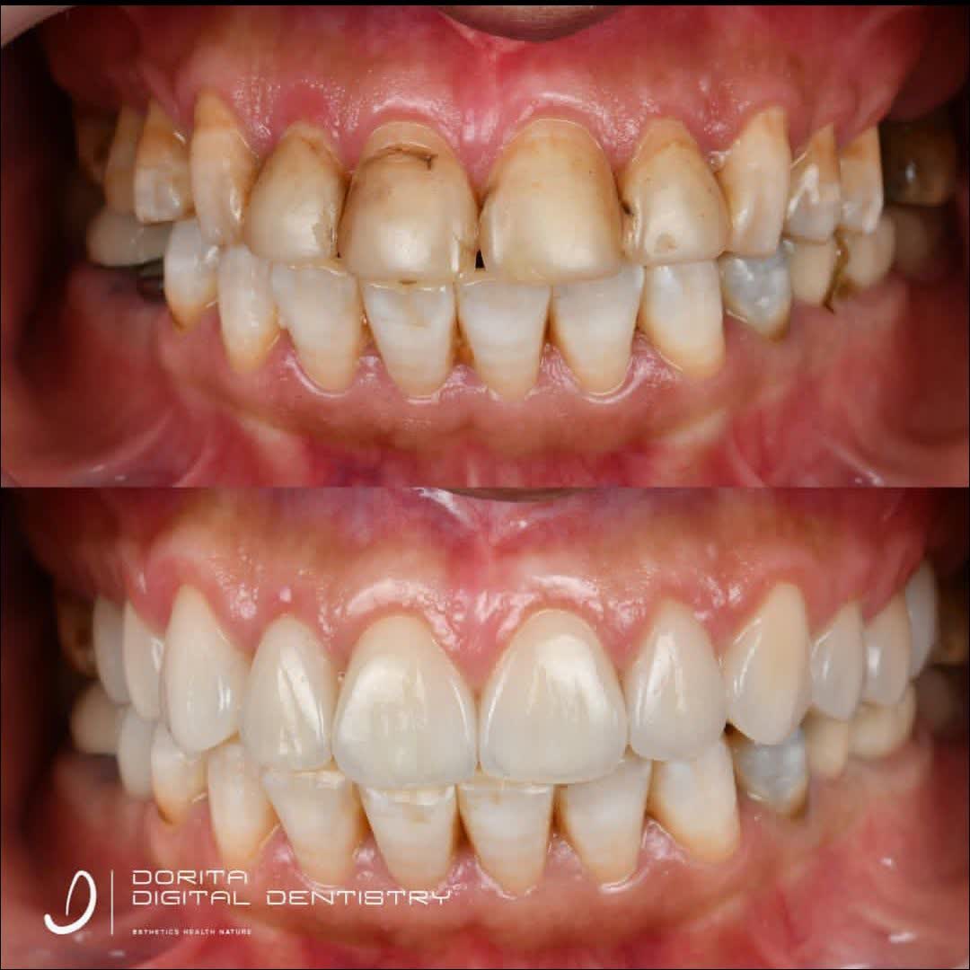 نمونه کار دکتر فرانک وکیلی | مطب ۳۶۵