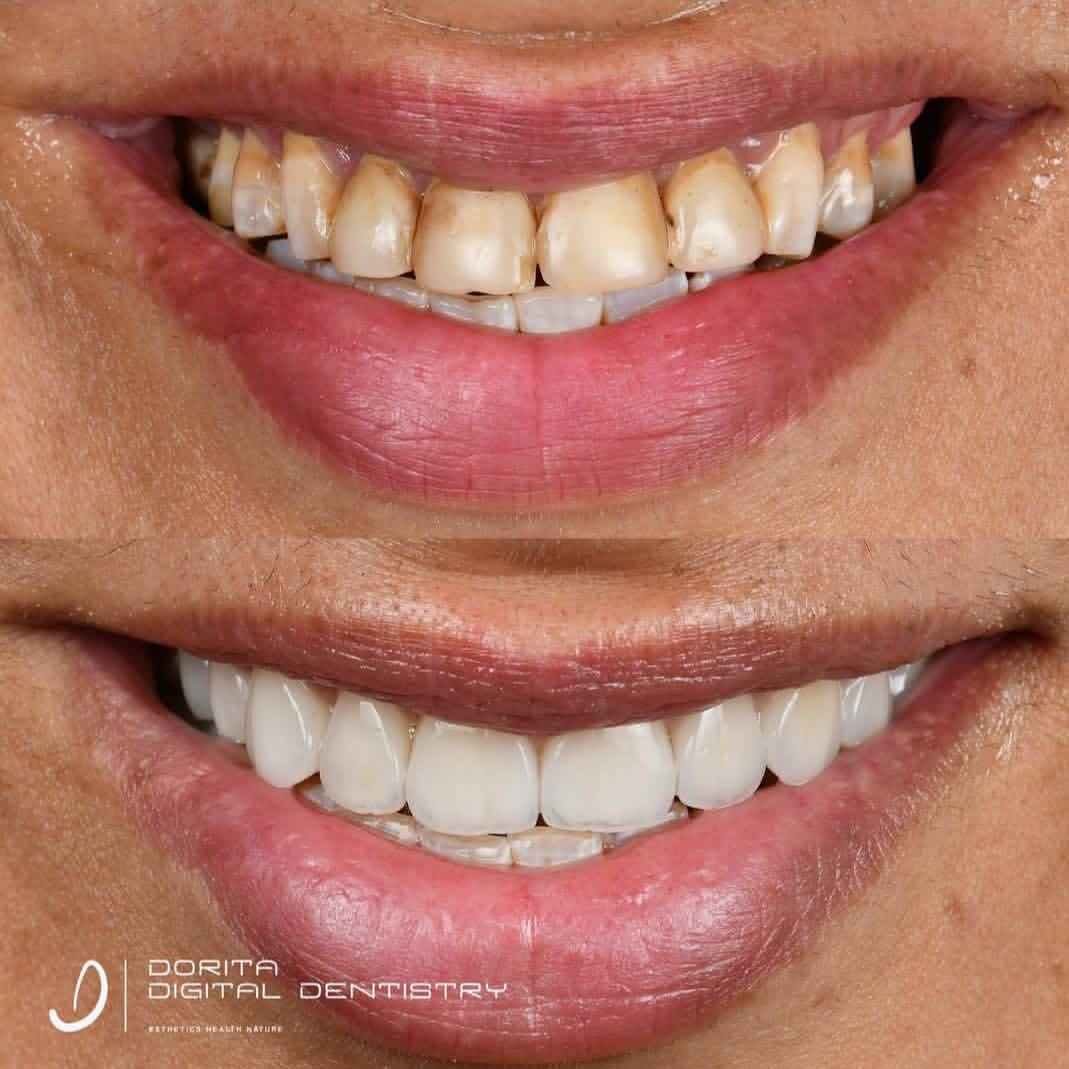 نمونه کار دکتر فرانک وکیلی | مطب ۳۶۵