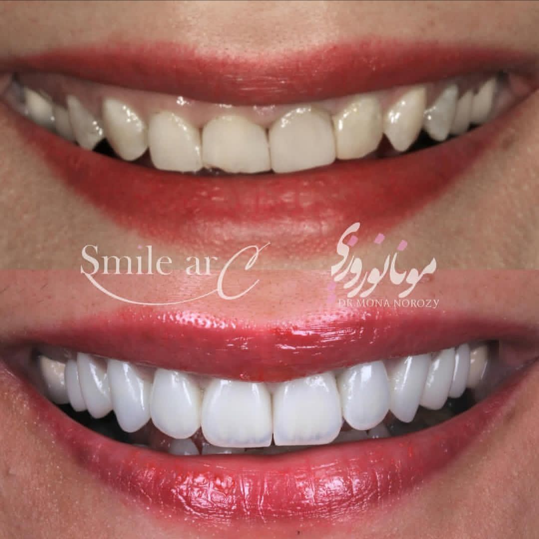 نمونه کار های دکتر مونا نوروزی | مطب ۳۶۵