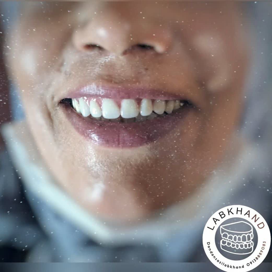 نمونه کار لابراتوار دندانسازی اصفهان لبخند | مطب ۳۶۵