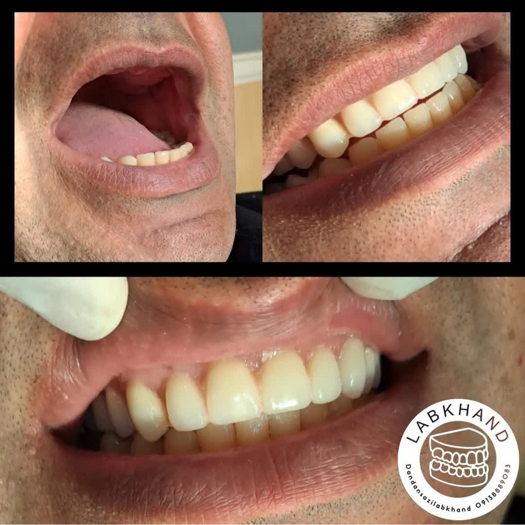 نمونه کار لابراتوار دندانسازی اصفهان لبخند | مطب ۳۶۵