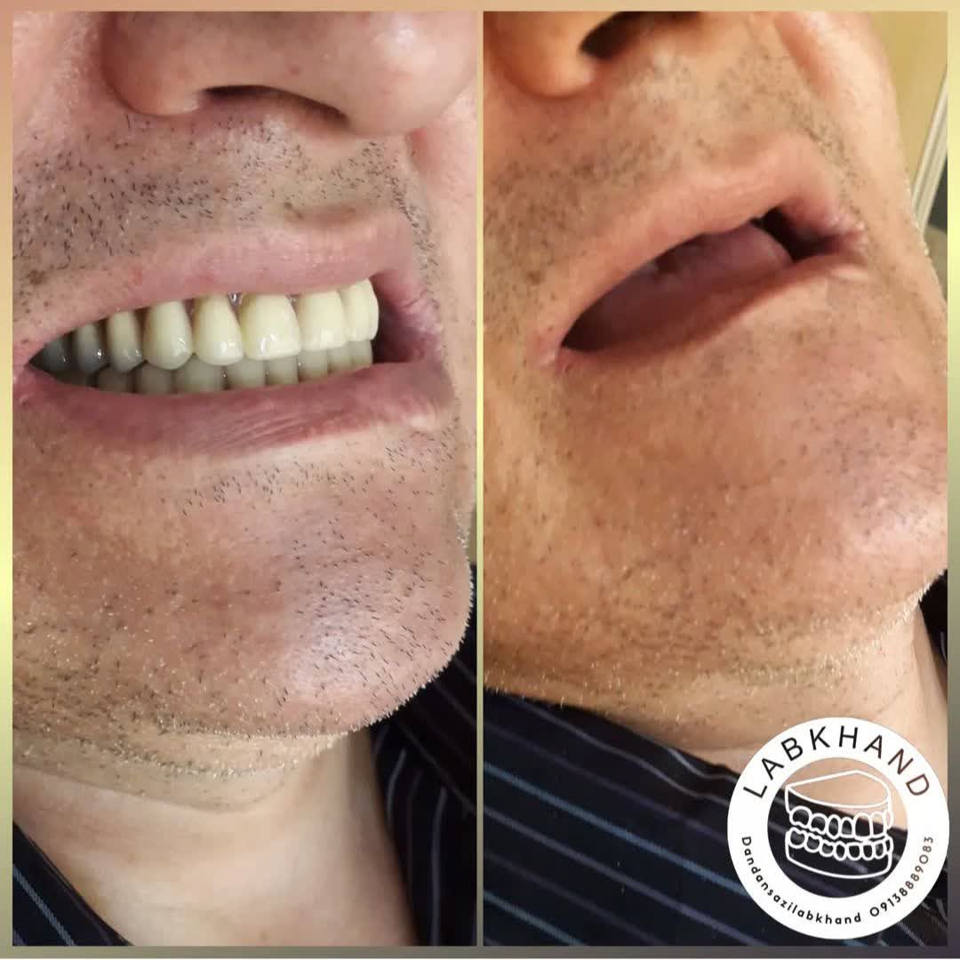 نمونه کار لابراتوار دندانسازی اصفهان لبخند | مطب ۳۶۵