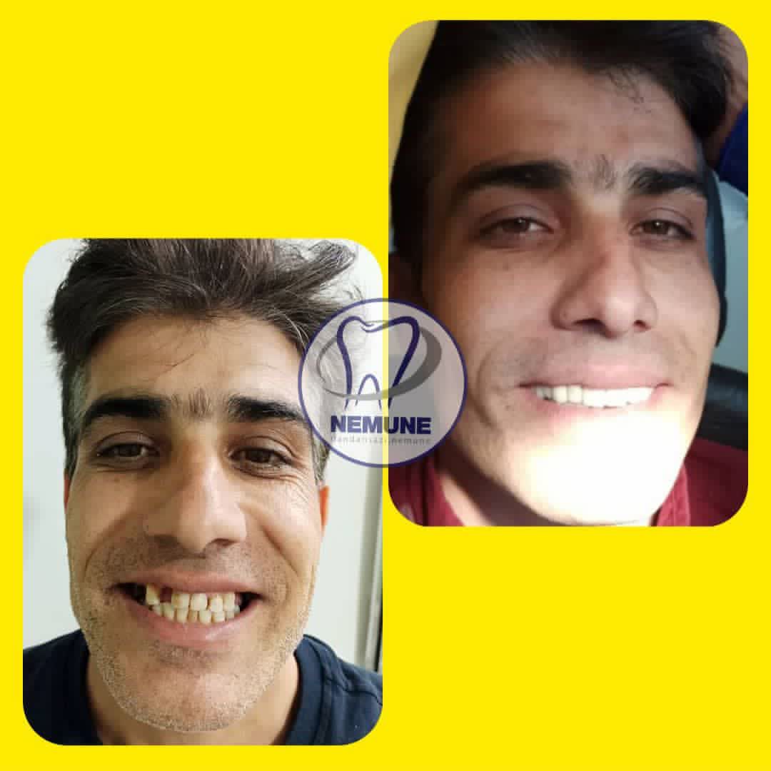 نمونه کار دندانسازی نمونه اصفهان | مطب ۳۶۵