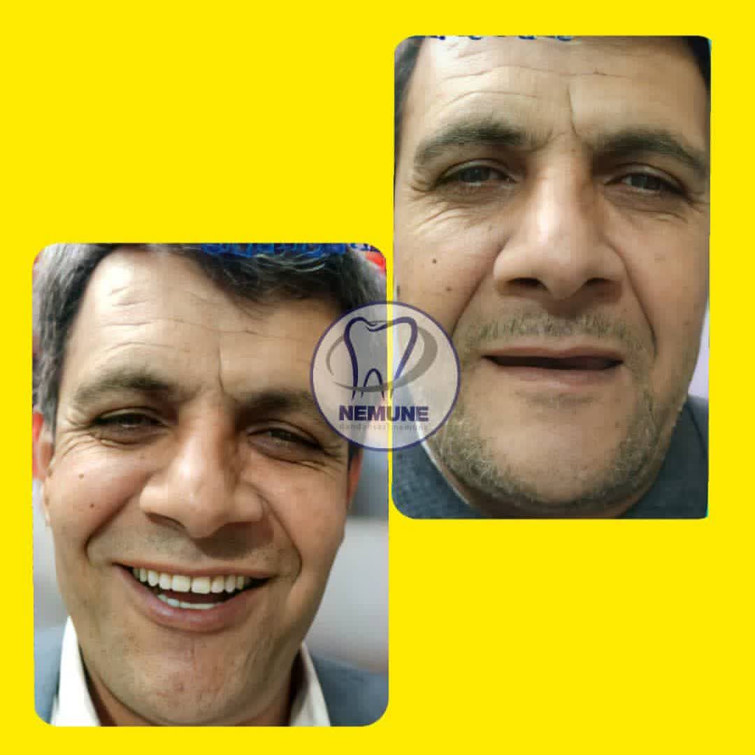 نمونه کار دندانسازی نمونه اصفهان | مطب ۳۶۵