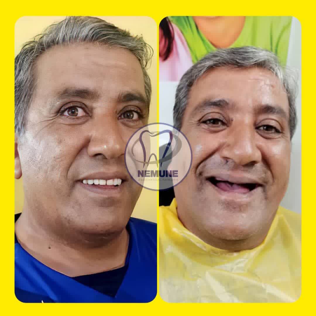 نمونه کار دندانسازی نمونه اصفهان | مطب ۳۶۵