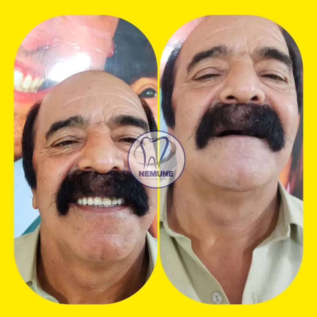 نمونه کار دندانسازی نمونه اصفهان | مطب ۳۶۵