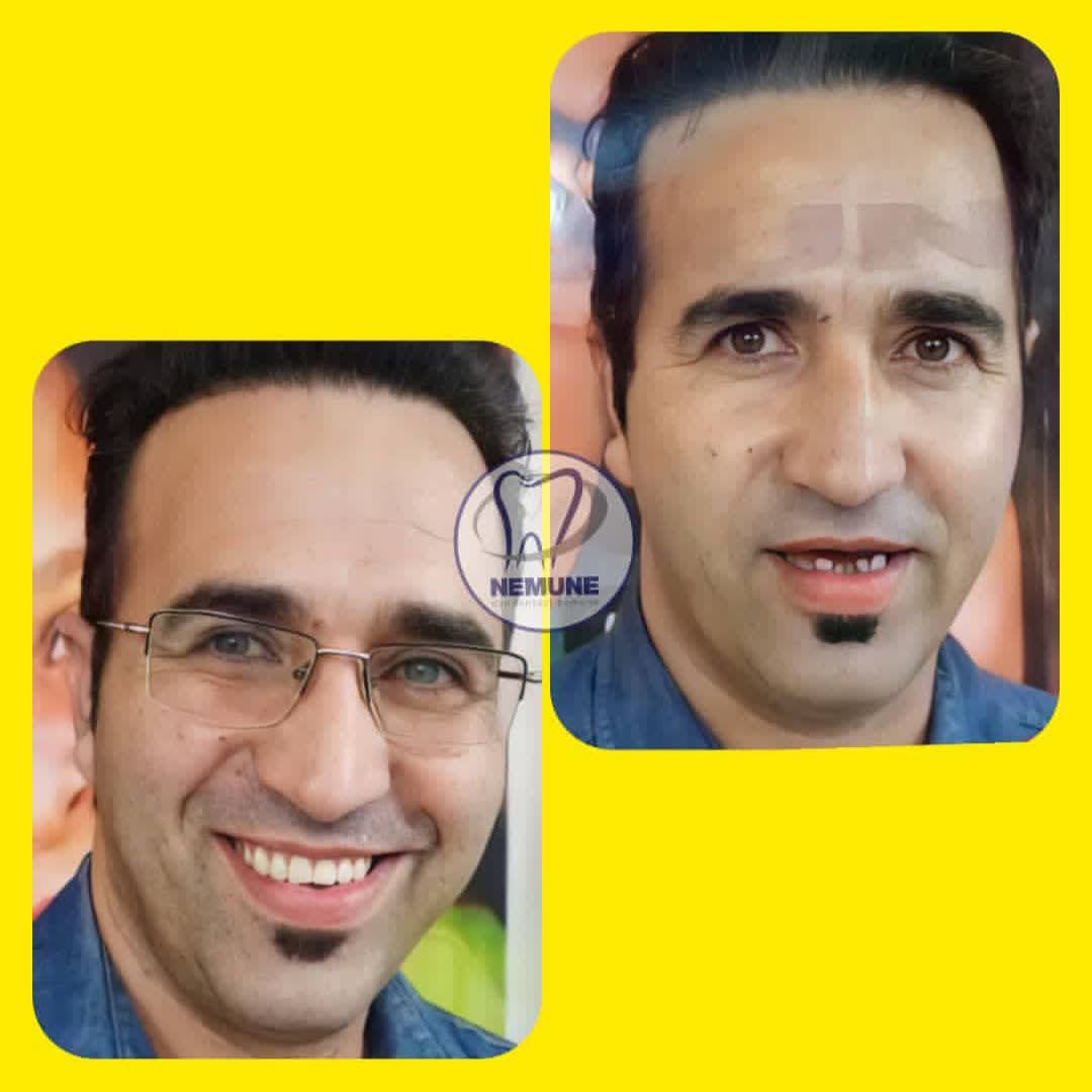 نمونه کار دندانسازی نمونه اصفهان | مطب ۳۶۵