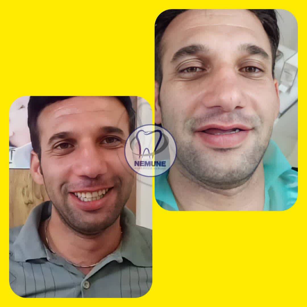 نمونه کار دندانسازی نمونه اصفهان | مطب ۳۶۵