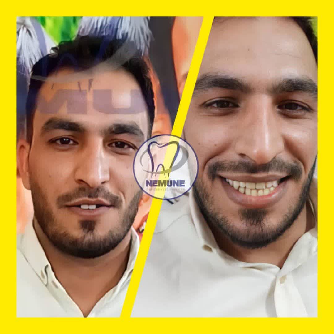 نمونه کار دندانسازی نمونه اصفهان | مطب ۳۶۵