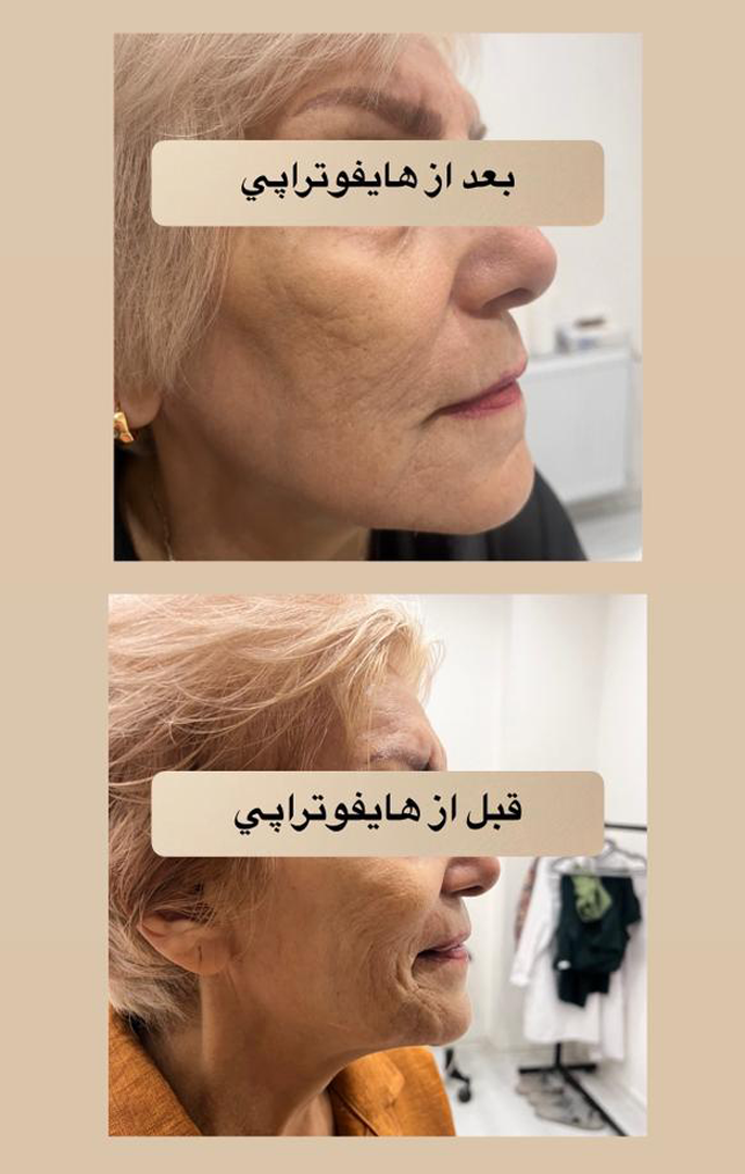 هایفوتراپی در اصفهان|دکتر شهرام آقاصالحه