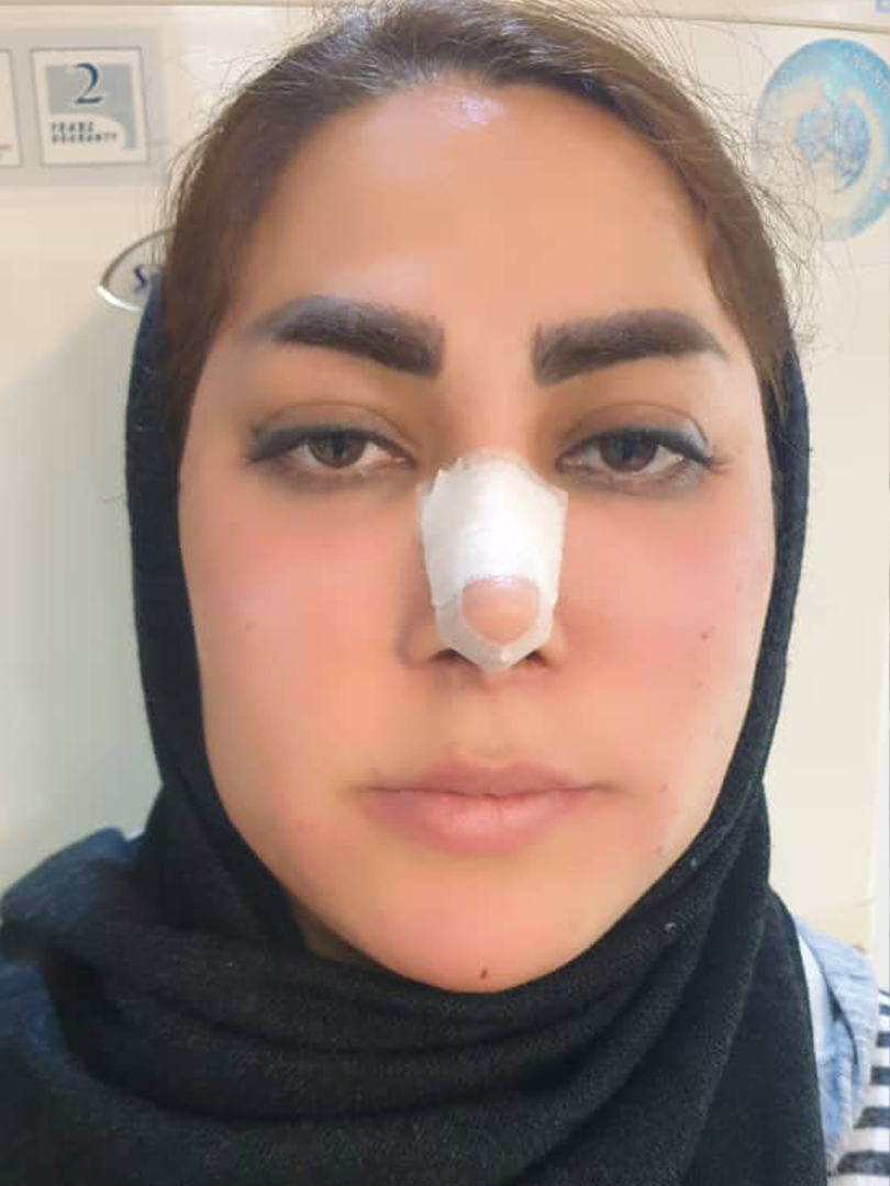 تزریق چربی در اصفهان| دکتر شهرام آقاصالحه