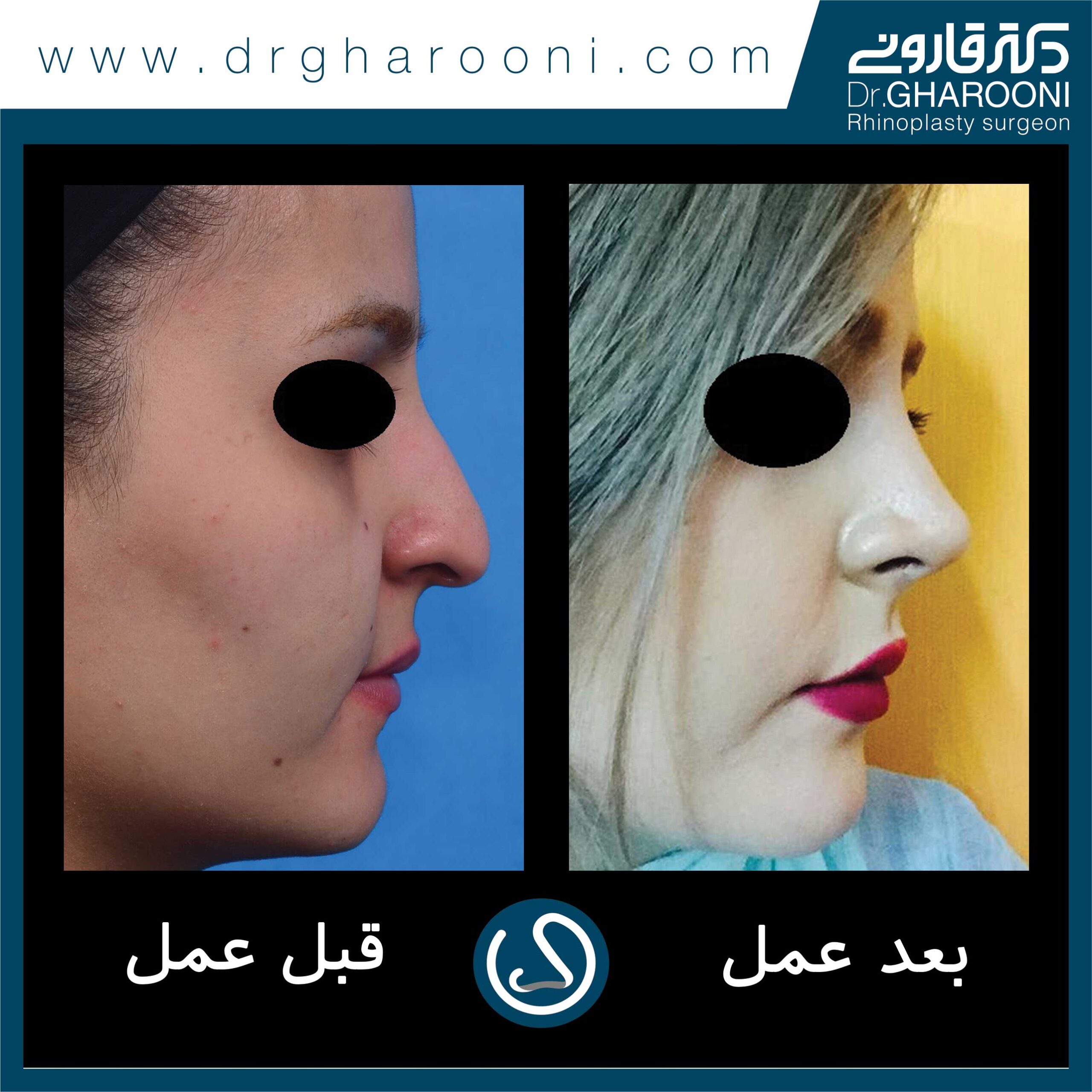 نمونه درمانی جراحی بینی دکتر قارونی