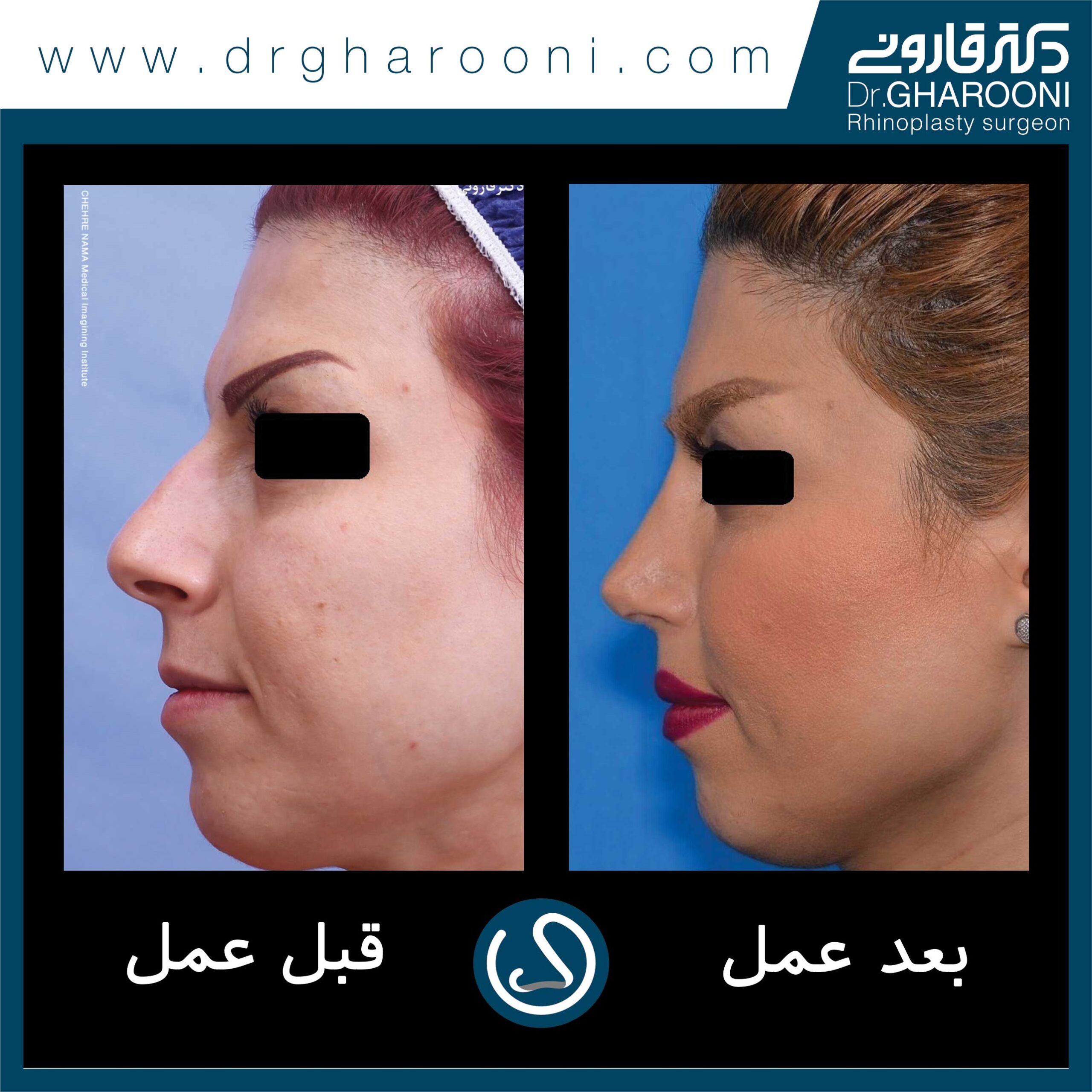 نمونه درمانی جراحی بینی دکتر قارونی