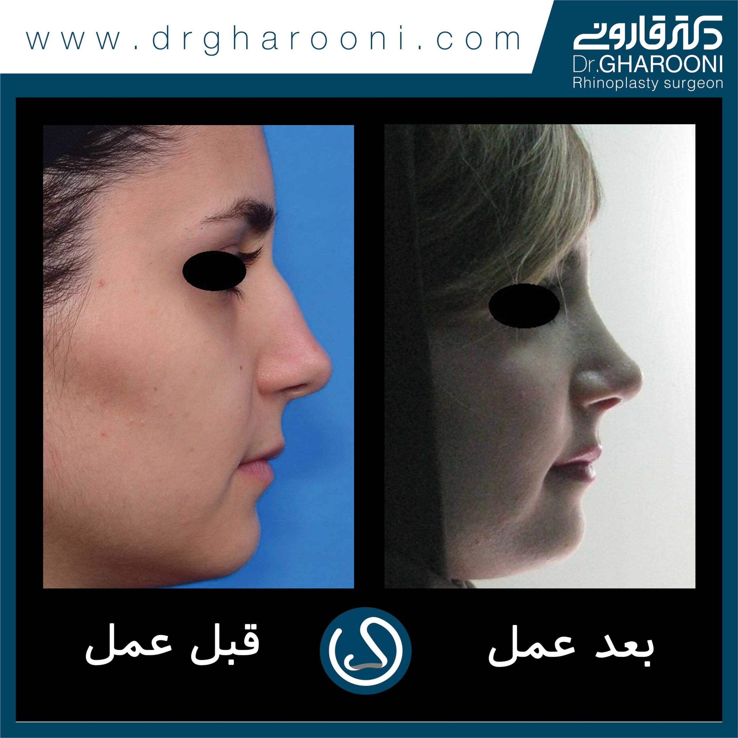 نمونه درمانی جراحی بینی دکتر قارونی