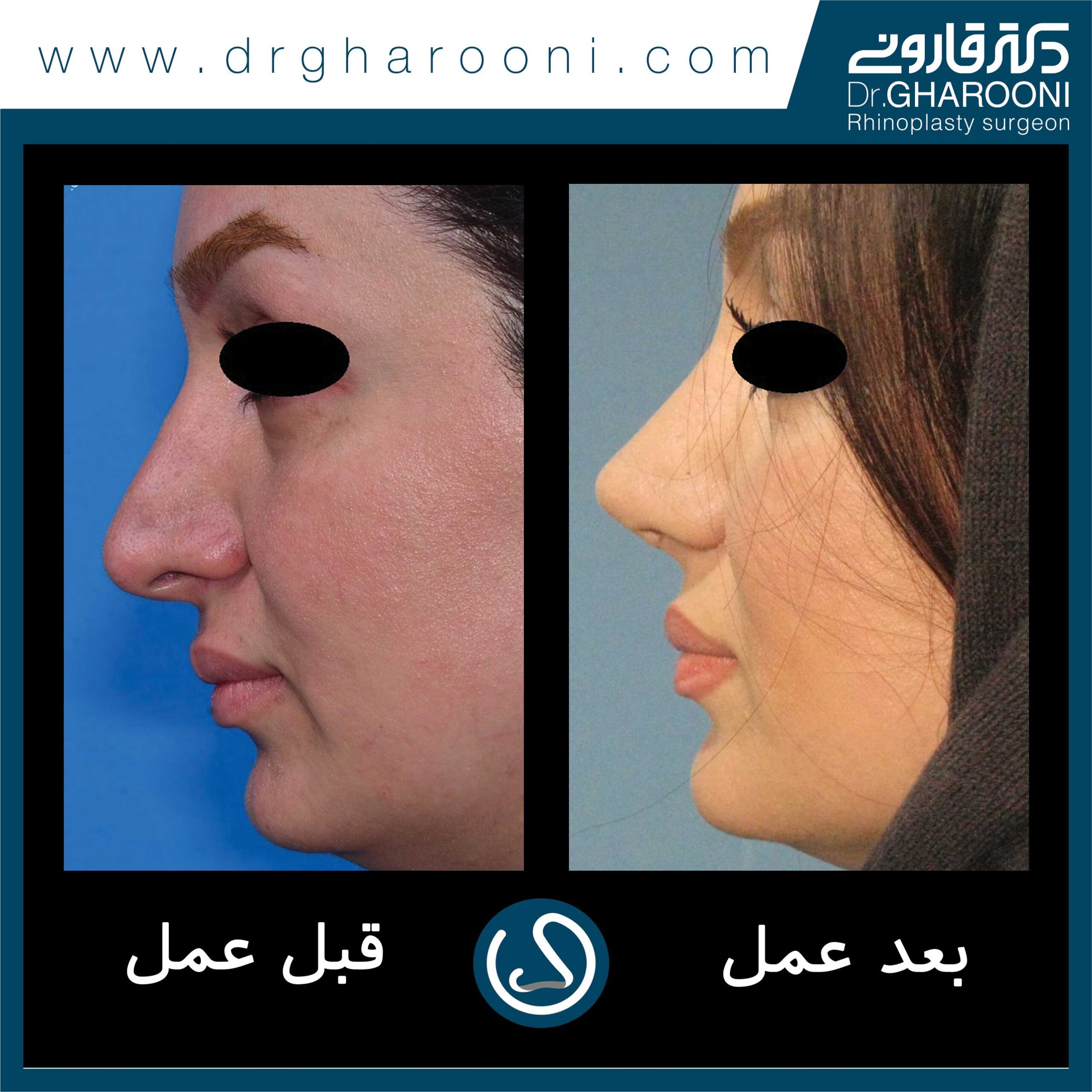 نمونه درمانی جراحی بینی دکتر قارونی