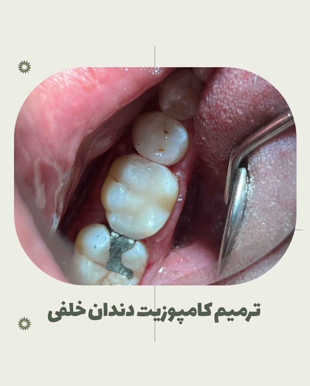 نمونه های درمانی دکتر گلشن فرزانه، متخصص دندانپزشکی ترمیمی و زیبایی در اصفهان