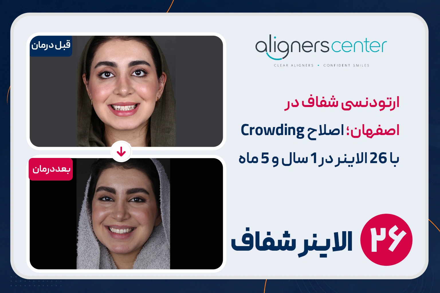 قبل و بعد ارتودنسی شفاف در اصفهان - اصلاح کراودینگ دو فک با ۲۶ الاینر