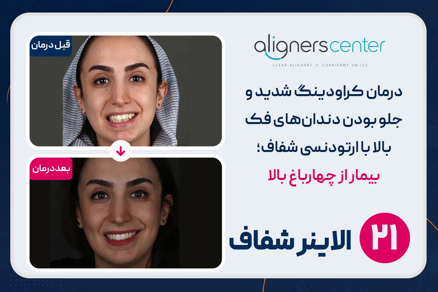 قبل و بعد ارتودنسی شفاف در اصفهان - کراودینگ و جلو بودن دندانهای بالا (اورجت)