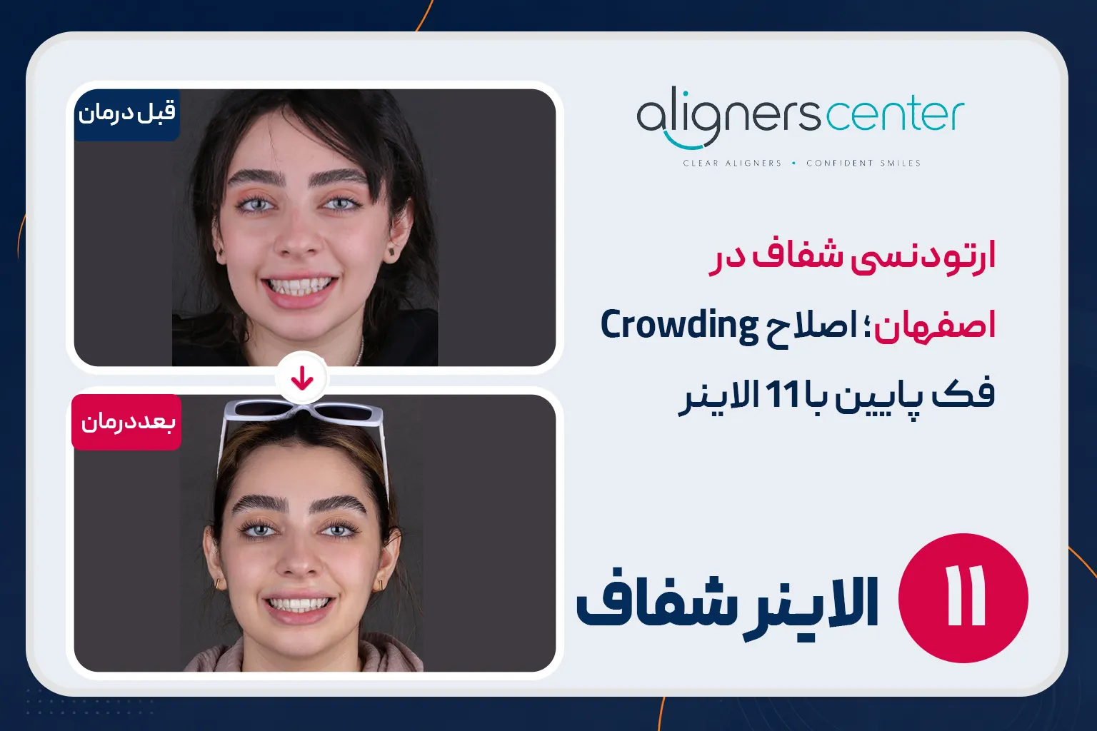 قبل و بعد ارتودنسی شفاف در اصفهان - اصلاح کراودینگ فک پایین با ۱۱ الاینر