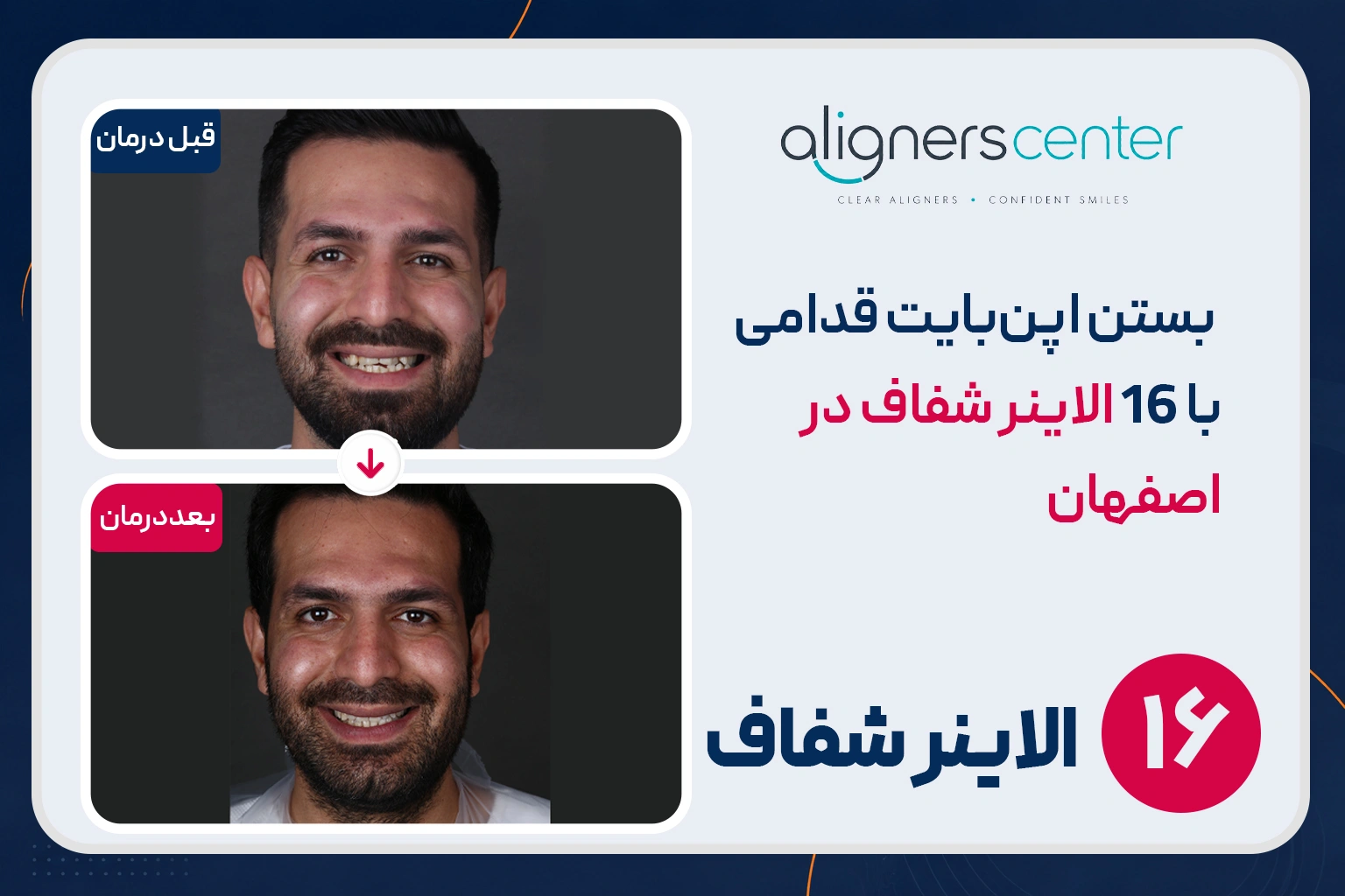 قبل و بعد ارتودنسی شفاف در اصفهان - بستن اپنبایت قدامی با ۱۶ الاینر