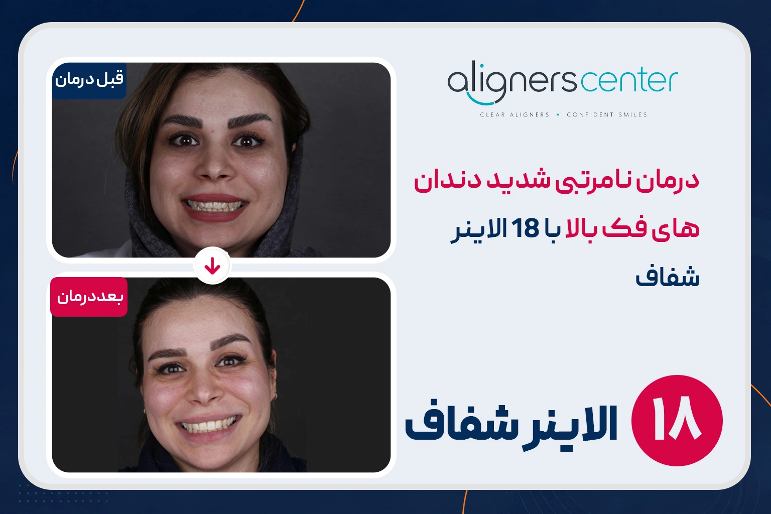 قبل و بعد ارتودنسی شفاف در اصفهان - نامرتبی شدید دندانهای فک بالا با ۱۸ الاینر